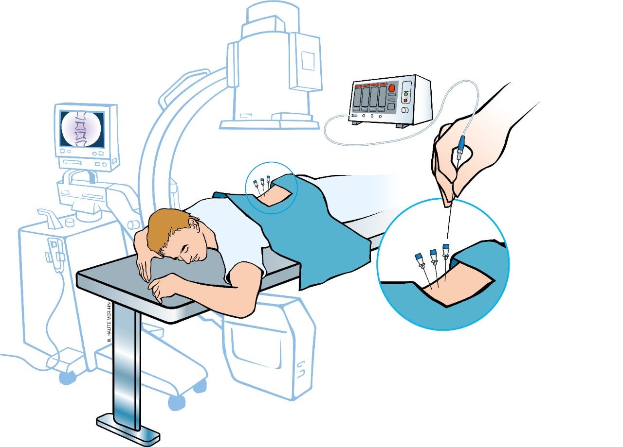 image du traitement thermocoagulation