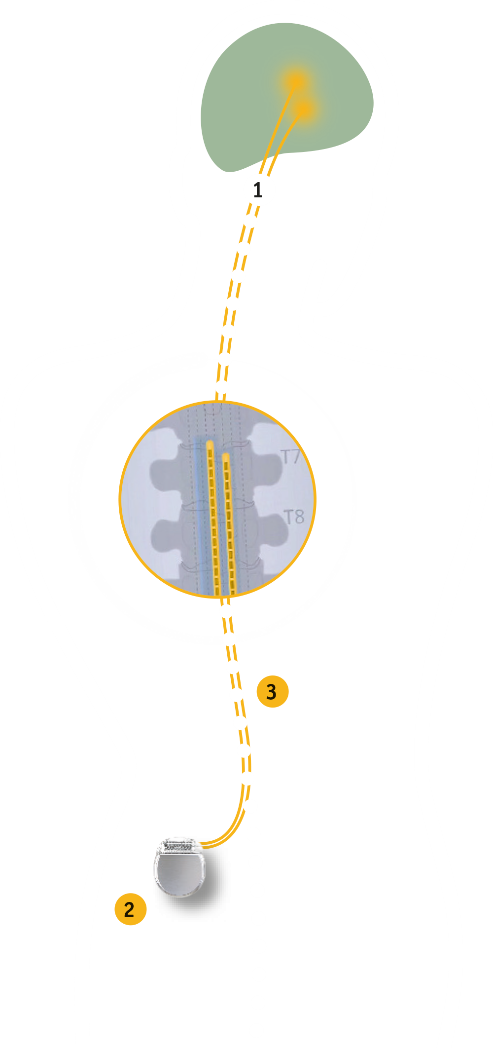 Stimulation médullaire dans le corps humain