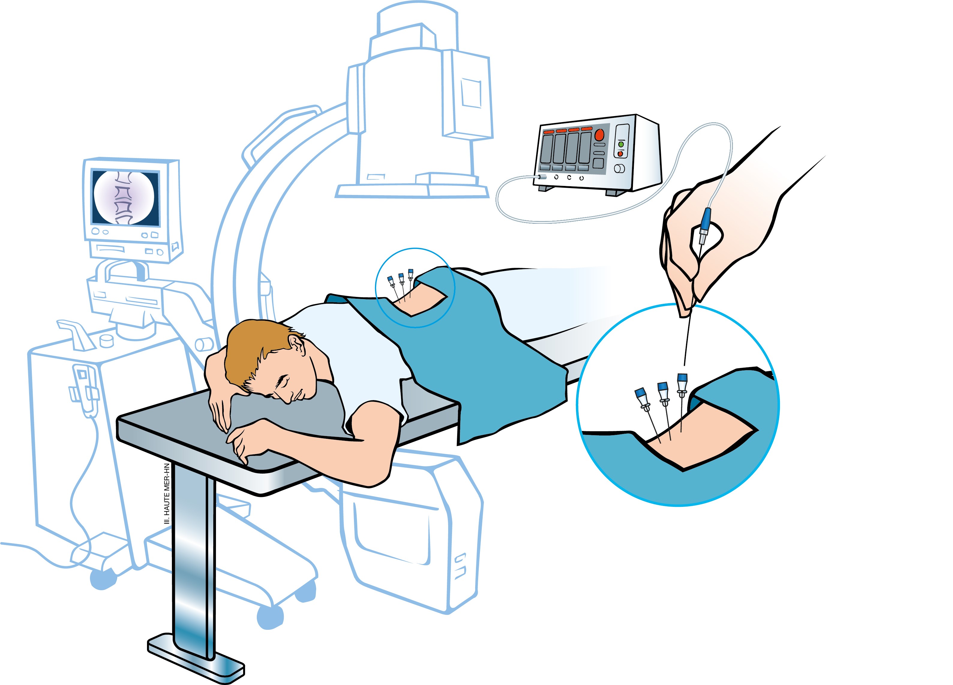 La thermocoagulation imagée