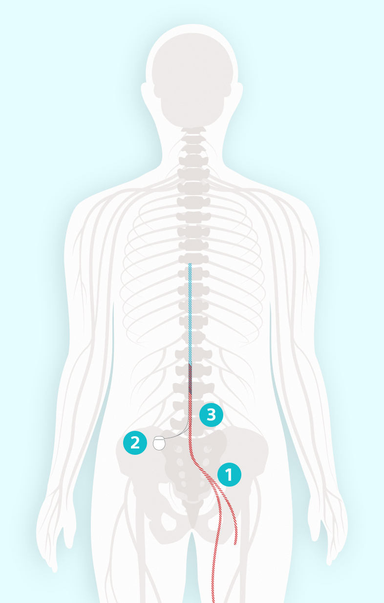 Image de la stimulation médullaire